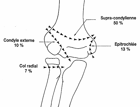 Pediaos fr Fractures Du Coude Chez L enfant