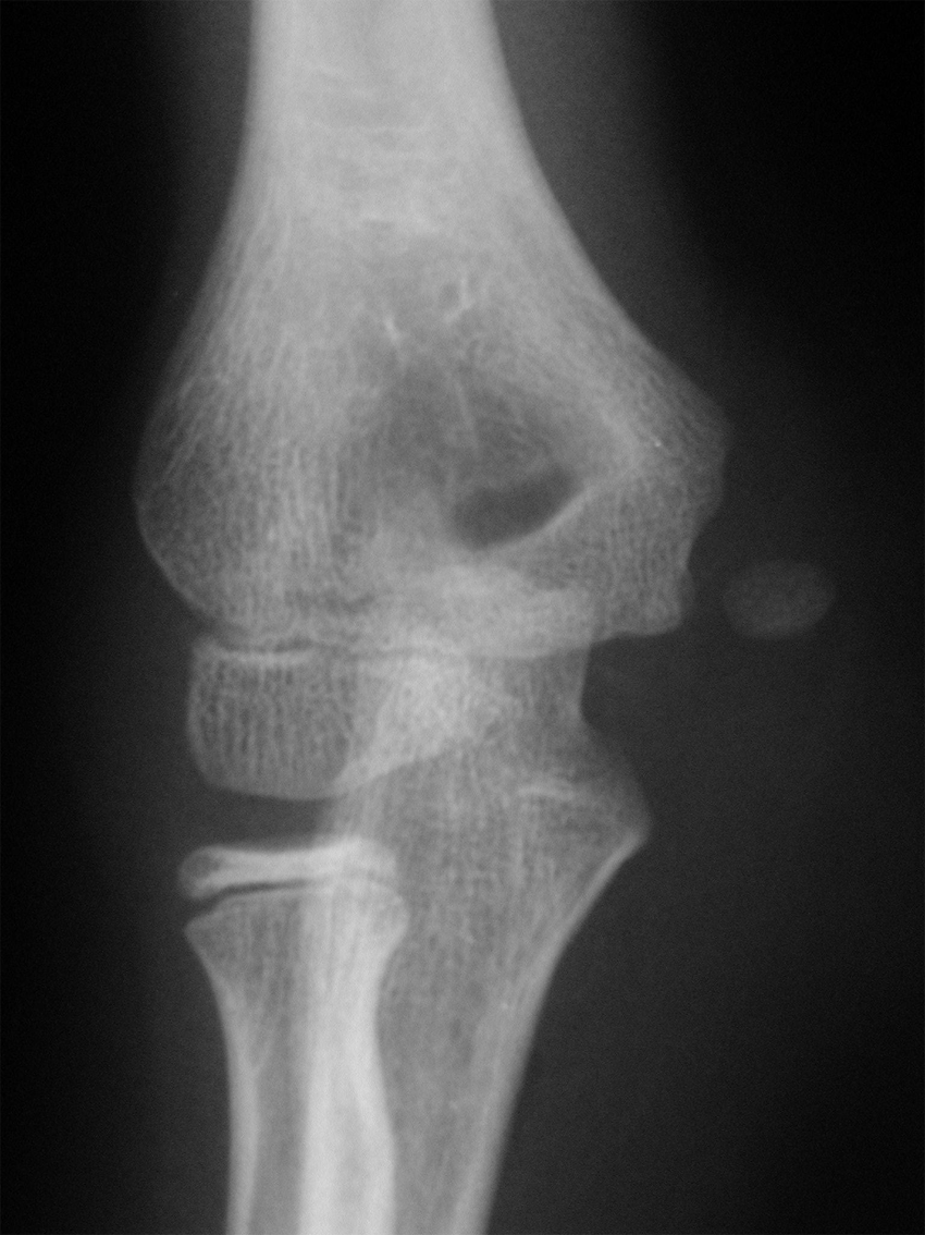 Pediaos fr Fractures Du Coude Chez L enfant