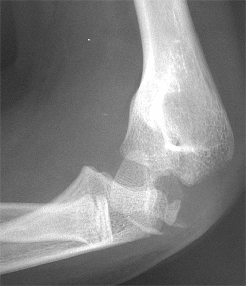 Pediaos fr Fractures Du Coude Chez L enfant