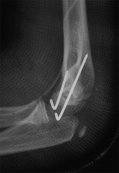 Pediaos fr Fractures Du Coude Chez L enfant