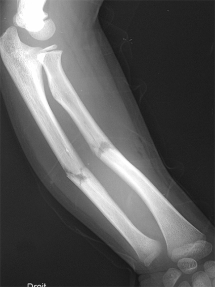 Radiographie des SFPD Avantbras6