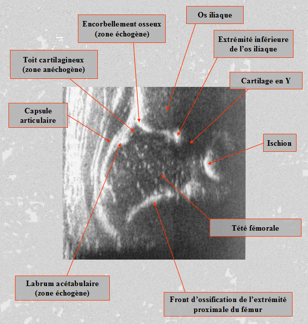 échographie hanche bébé 4 mois