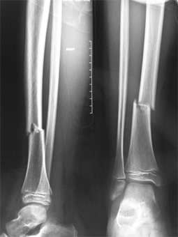 Pediaos.fr: Fractures de la jambe chez l'enfant