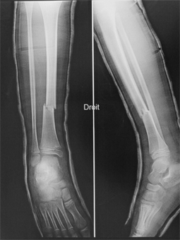 Pediaos.fr: Fractures de la jambe chez l'enfant