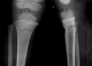 Pediaos.fr: Fractures de la jambe chez l'enfant
